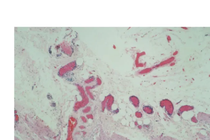 Fig. 2. Histological finding. It shows irregularly dilated, distorted, thin-walled vessels in submucosa (H&amp;E stain, ×100).