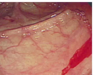 Fig. 3. Endoscopic finding. It shows active bleeding in the trans- trans-verse colon.