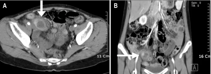 Fig.  1.  Abdomen  computed  tomography.  (A)  Appendix  has  increased  diameter  and  cystic  mass  like  lesion  which  measures  2.6×2.0  cm  at  mid  portion