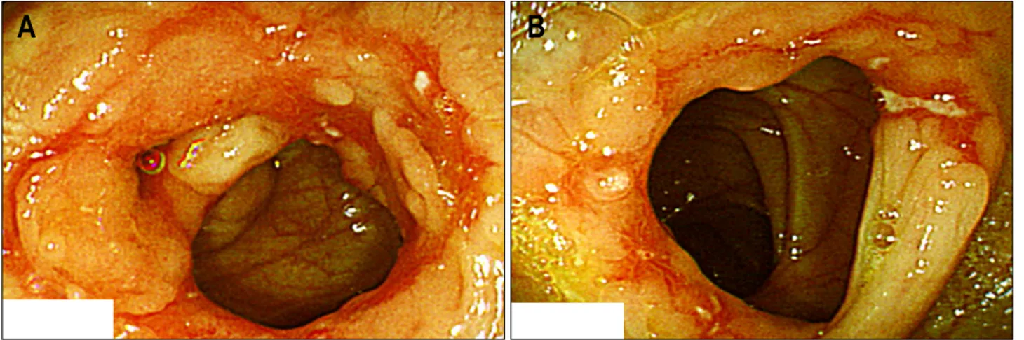 Fig.  4.  Colonoscopic  findings.  Multiple  circular,  healed  ulcerations  are  observed  at  ileocaecal  valve,  hepatic  flexure,  transverse  colon,  and  descending  colon