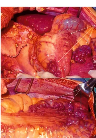 Fig. 2. Computed tomography of abdomen. It shows markedly dilated proximal portion of portal vein (black arrow) and multiple collateral vessels (white arrow).