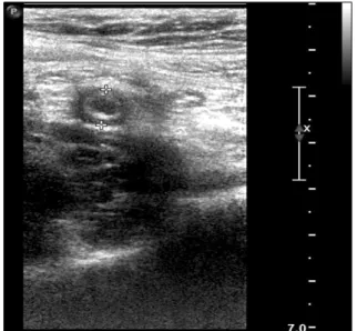 Fig.  1.  A  transverse  ultrasound  scan  shows  a  dilated  appendiceal  stump  measuring  8  mm  in  diameter.