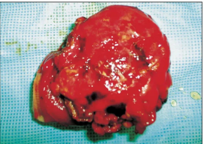 Fig.  3.  Microscopic  finding  of  the  resected  mass  shows  sulfur  granules  in  abscess  (H&amp;E,  ×200).