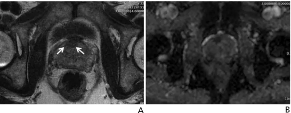 Figure 7.  Diffusion weighted image of prostate cancer. (A) T2 weighed axial scan shows suspicious ill- defined low  signal intensity area in anterior transitional zone (arrows)