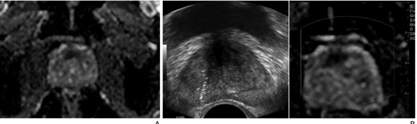 Figure 9.  Magnetic resonance imaging-ultrasonography fusion image of prostate cancer