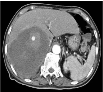 Fig.  2.  Celiac  angiography  shows  microcoil  embolization  of  a  bleeding  segmental  branch  of  S7  hepatic  artery.