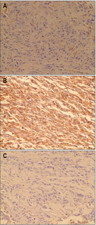 Fig.  4.  Histologic  findings  of  the  main  hepatic  tumor.  Immuno- Immuno-histochemical  staining  was  performed  for  (A)  vimentin,  diffuse  mildly  to  moderately＋stain  (×100),  (B)  smooth  muscle  actin,  75%,  moderately  to  strong＋stain  (×