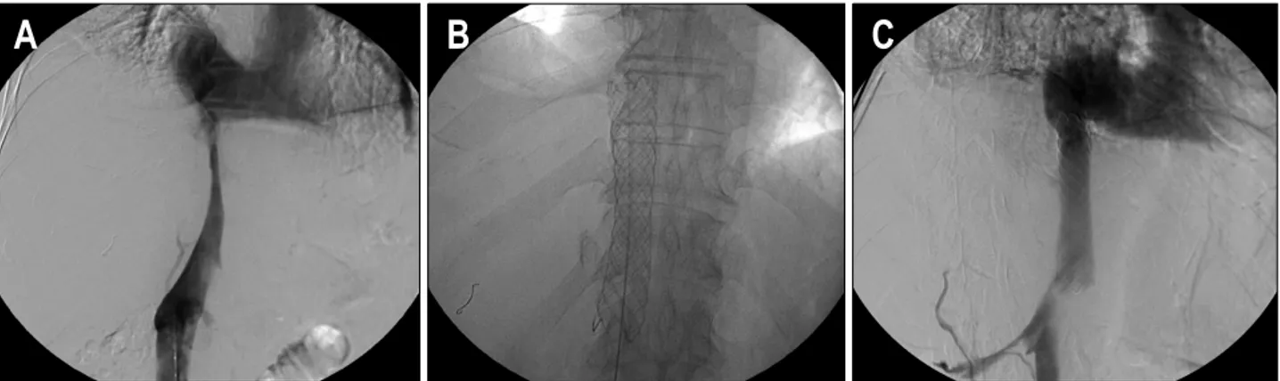 Fig.  5.  IVC  stent  insertion.  (A)  Severe  luminal  stenotic  lesion  (more  than  80%)  of  hepatic  segment  of  IVC  are  noted