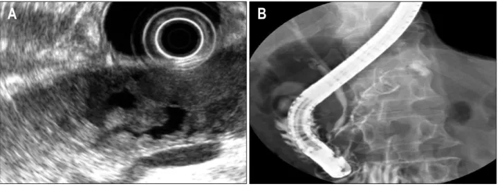 Fig.  4.  (A)  EUS  shows  marked  dilatation  of  the  main  pancreatic  duct  with  a  solid,  protruding  mass