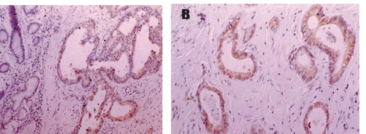 Fig.  1.  Immunohistochemical  staining  of  human  gastric  cancer  with  anti-CD40  antibody
