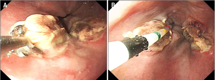 Fig.  1.  After  7  days  after  EVL,  endoscopic  finding  showed  the  measurement  of  size  of  post-EVL  ulcer