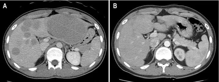 Fig.  1.  Abdominal  CT.  (A)  Abdominal  CT  scan  shows  multiple  variable  sized  low  density  nodules  on  the  liver  and  kidney,  and  the  largest  one  was  11×7  cm  on  the  lateral  segment  of  left  lobe  of  liver  (Lt.)