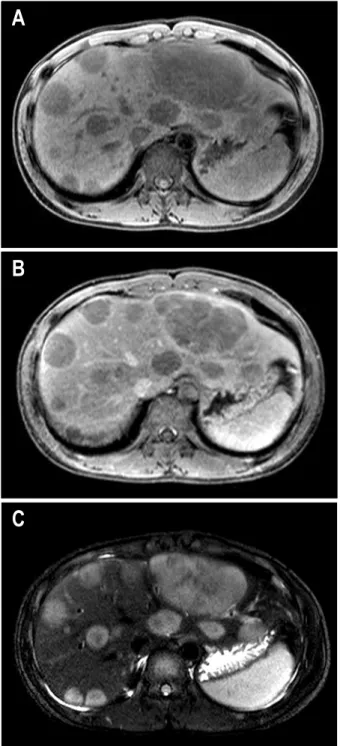Fig.  2.  Abdominal  MRI.  (A)  (B)  T1-weighted  image  shows  low  signal  intensity  in  liver  with  poor  enhancement