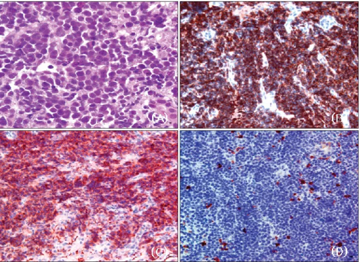 Fig.  3.  Microscopic  findings  of  the  liver.  (A)  Diffusely  infiltrating  medium-sized  cells  with  basophilic  cytoplasm,  coarse  chromatin,  and  medium-sized  nucleoli  are  seen  (H&amp;E  stain,  ×1000)