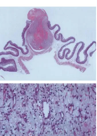 Fig.  3.  Macroscopic  finding  of  the  resected  specimen.  It  shows  a  dome-shaped  nodular  mass  (1  cm  in  the  dimension).