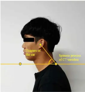 Figure 1.  Craniovertebral angle