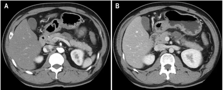 Fig.  3.  Follow-up  abdominal  computed  tomography  (CT).  Follow-up  abdominal  CT  taken  on  the  45th  day  after  first  image  shows  im- im-proved  pancreatic  edema  and  a  focal  low  attenuation  in  pancreatic  body  portion  (A)  and  imim-p