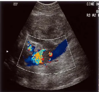 Fig.  4.  Microscopic  findings.  (A)  Variable  sized  smooth  muscle  cells  with  frequent  mitosis  in  the  whorling  pattern  are  demonstrated  (H&amp;E  stain, 