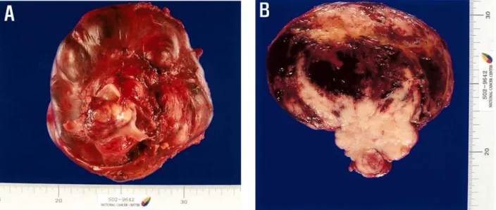 Fig.  5.  Gross  finding  of  the  specimen.  (A)  An  encapsulated  yellowish  hard  mass  with  polypoid  mass  in  IVC  lumen  is  noted