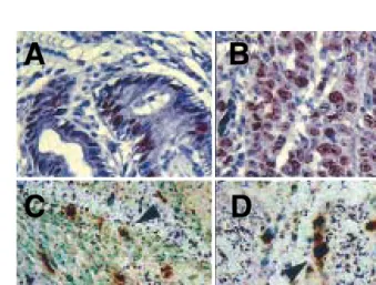 Fig. 1. Microscopic finding of the gastric mucosa. (A, B) Nuclear immunostaining of Ki-67 in gastric tissue from chronic gastritis and adenocarcinoma patients (×400)