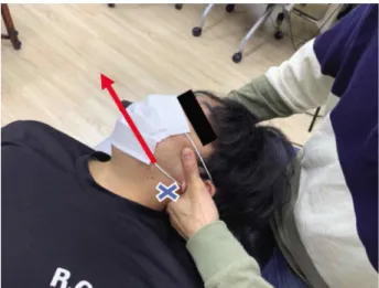 Figure 1.  Upper Cervical Manipulation. Red arrow indicates  line  of  drive.  Blue  X  indicates  the  segmental  contact  point (posterior arch of C1).