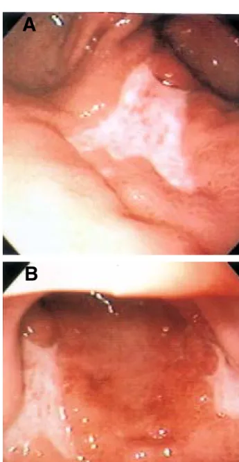Fig. 1. Gastroscopic finding. Multiple active geographic ulcers are noted in (A) the distal body and (B) the antrum.