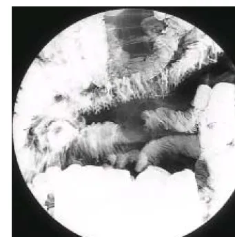 Fig. 1. Small bowel series. A short segmental concentric luminal narrowing without definite shouldering and mild dilatation of the proximal bowel to the narrowed segment are noted at the proximal jejunum.