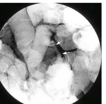 Fig. 4. Gross finding of the stricture site. Cross section shows a whitish tan homogenous solid mass in the submucosa, muscle and subserosal layer, and mucosal surface erosion.