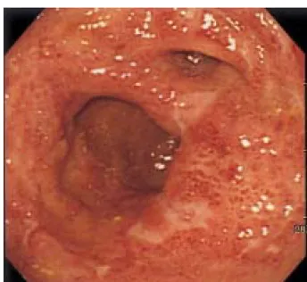 Fig. 3. Poucheoscopy. It shows marked erythema and multiple ulcer- ulcer-ations.