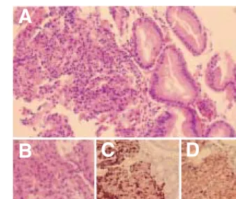 Fig. 2. Microscopic finding. (A) It shows compact groups of small round tumor cells of uniform structure (H&amp;E stain, ×100)
