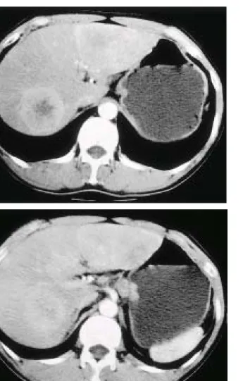 Fig. 3. Abdominal CT finding. (A) It shows multiple scattered, variable sized masses in both lobes, which are enhanced peripherally in the arterial phase