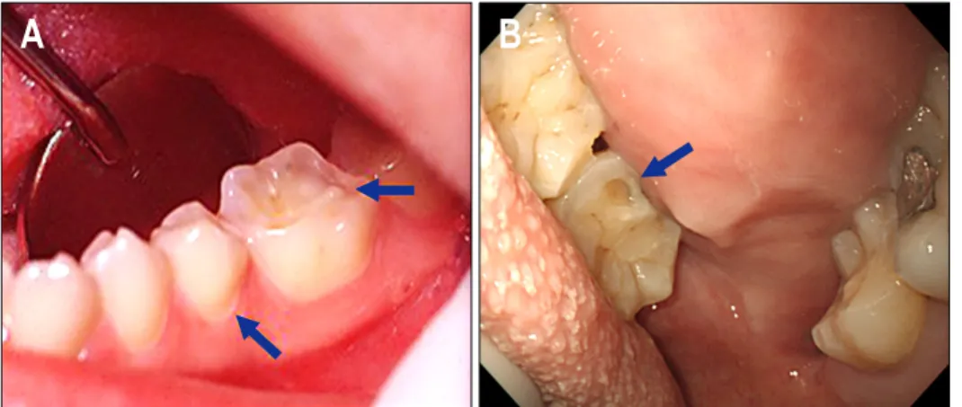 Fig.  2.  Dental  erosions  (arrow)  found  during  the  dental   examina-tion  (A,  Gandara  BK  et  al