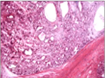 Fig.  2.  Gross  finding  of  the  resected  specimen.  It  shows  the  45×35  mm  sized  resected  specimen