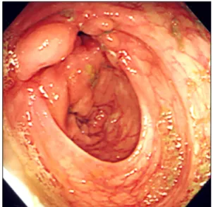 Fig.  1.  Colonoscopic  finding  shows  mucosal  nodularity  with  ul- ul-ceration  resulting  in  deformity  of  ileocecal  valve  and  cecum.