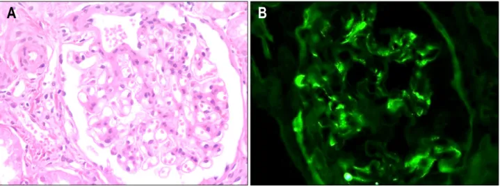 Fig.  3.  Microscopic  findings  of  a  renal  biopsy  specimen.  (A)  A  glomerulus  shows  mild  mesangial  hypercellularity  with  mesangial  matrix  expansion  (H&amp;E,  ×300)