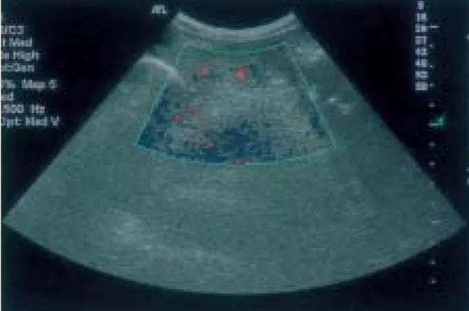 Fig. 2. Color Doppler ultrasonographic finding. It shows mosaic appearance of the lesions.