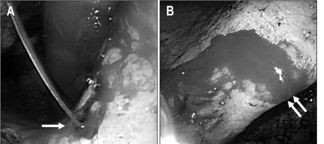 Fig.  1.  Endoscopic  images  show  active  gastric  ulcers  bleeding  in  a  patient  taking  NSAID  and  warfarin  (A,  arrow)  and  a   pa-tient  taking  two  different  kinds  of  NSAIDs  (B,  double  arrow).