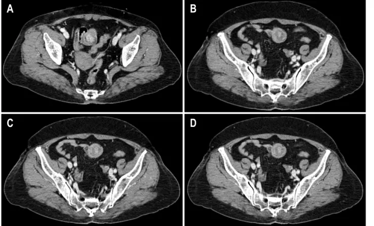 Fig.  1.  Abdominal  CT  findings.  (A)  About  2  cm  sized  intraluminal  enhancing  mass  is  seen  at  a  leading  end  of  the  intussuceptum
