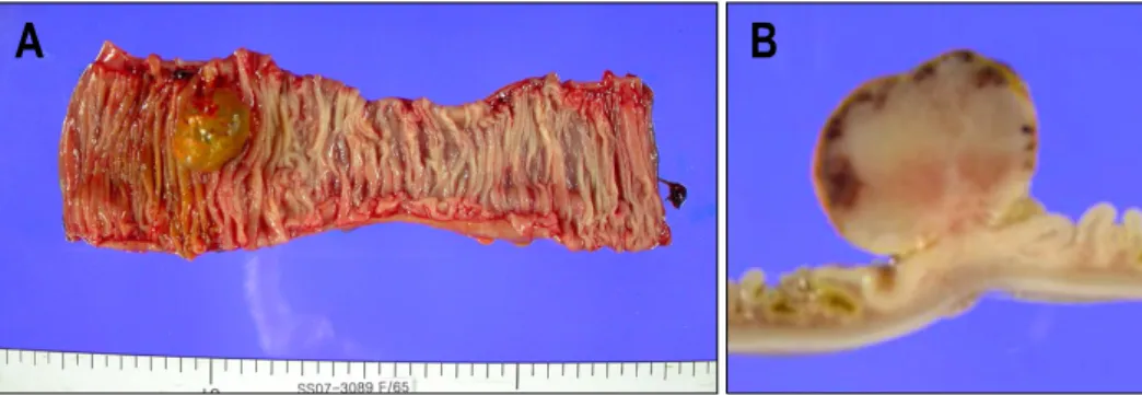 Fig.  4.  Microscopic  findings  of  the  small  bowel  mass.  (A)  The  topmost  surface  of  the  mass  shows  total  denudation  of  the  mucosa  with  submucosal  proliferation  of  irregularly  shaped  blood  vessels  of  various  sizes  (H&amp;E,  ×1
