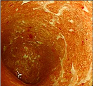 Fig.  1.  Colonoscopic  findings.  It  shows  diffuse  mucosal  hyper- hyper-emia  and  multiple  ulcerations  from  rectum  to  transverse  colon.