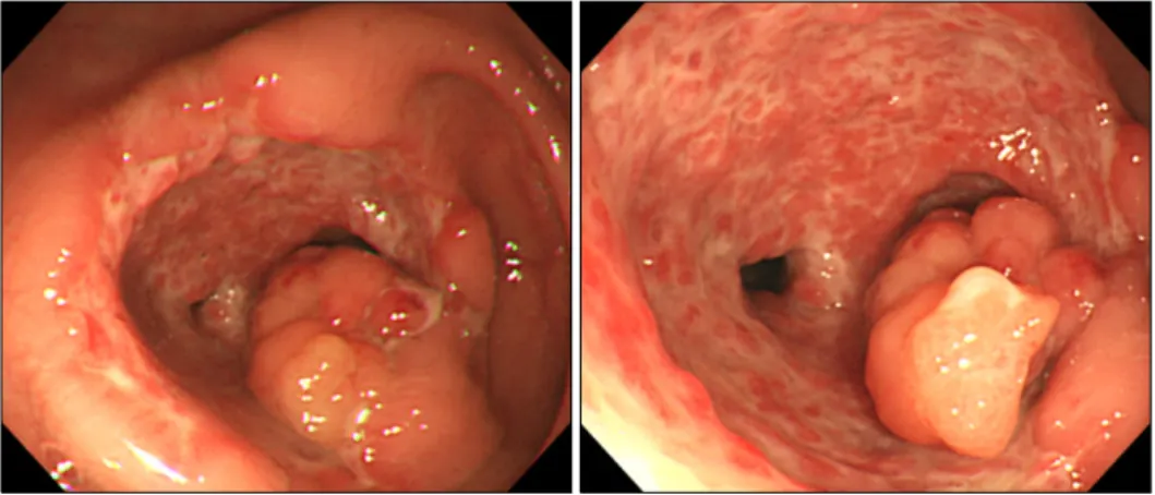 Fig.  1.  Initial  colonoscopic  find- find-ings.  A  protruding  polypoid  mass  with  surface  nodularity  is  noted  at  the  ileocecal  area