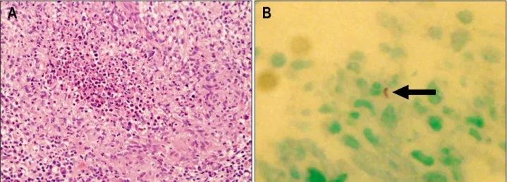 Fig.  3.  Histologic  findings.  (A)  It  shows  ill-defined  chronic  granulomatous  inflammation  with  caseation  necrosis  (H&amp;E  stain,  ×200)