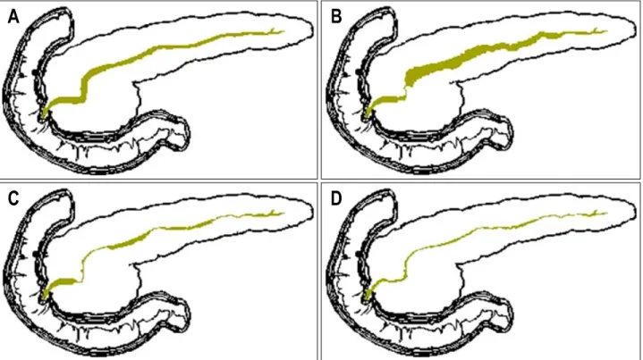 Fig.  1.  Pancreatic  ductal  change  in  autoimmune  pancreatitis.  (A)  Figure  shows  a  normal  pancreatic  duct