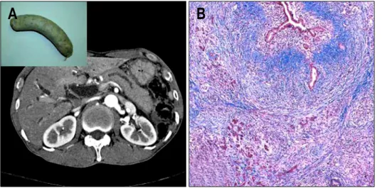 Fig.  2.  Abdominal  CT  and  histo- histo-logic  findings.  (A)  CT  scan  demonstrates  diffuse  pancreatic  enlargement  without  significant  peripancreatic  infiltration   (“saus-age-shaped  pancreas”)
