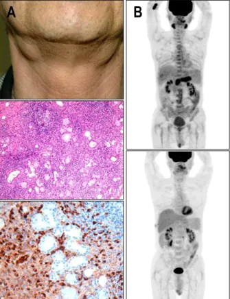 Fig.  6.  Salivary  gland  involvement  in  a  patient  with  autoimmune  pancreatitis