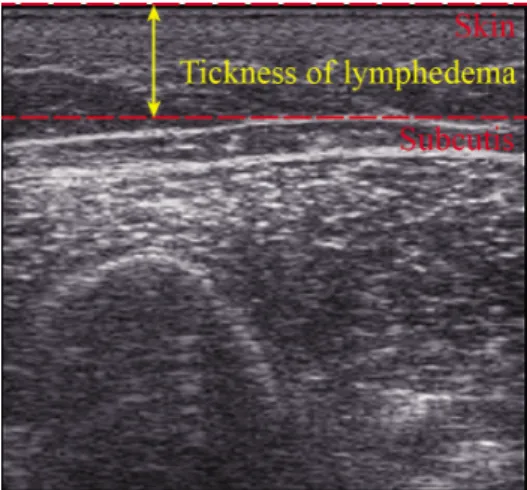 Figure 1. The thickness of breast cancer-related lymphedema. Yel- Yel-low arrow indicated ultrasound images of lymphedema  demon-strating the thickness of the skin, subcutis tissue, and their sum  with maximal compression.