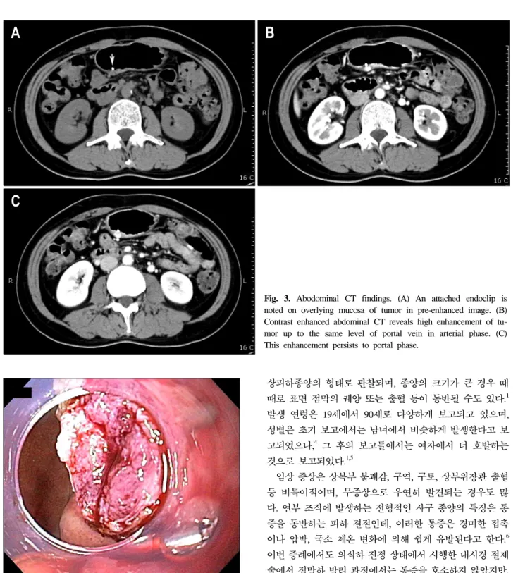 Fig.  4.  Endoscopic  finding.  After  partial  unroofing  of  overlying  mucosa,  exposed  tumor  appeared  fleshy  reddish  in  color  and  soft  in  consistency