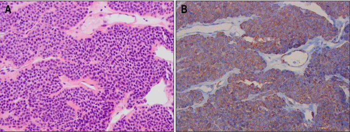Fig.  5.  Histologic  findings.  (A)  The  tumor  is  composed  of  sheets  of  uniform  small  round  cells  around  abundant,  variable  sized  dilated  vessels