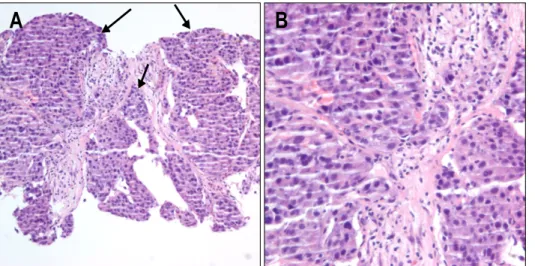 Fig.  1.  Liver  dynamic  CT  scan.  In  arterial  phase  (A),  multiple  hepatic  masses  with  peripheral  enhancement  are  noted  (black  arrow)