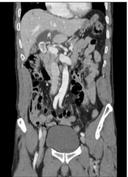 Fig.  1.  Abdominal  CT  finding  shows  a  large  CBD  stone  with  proximal  ductal  dilatation.